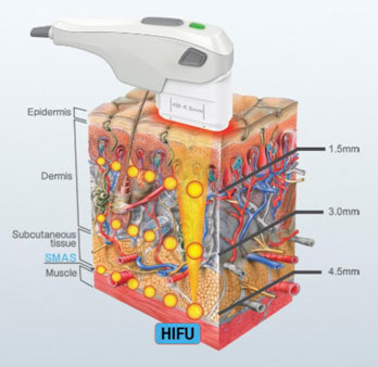 Tratamiento Ultralifting Málaga