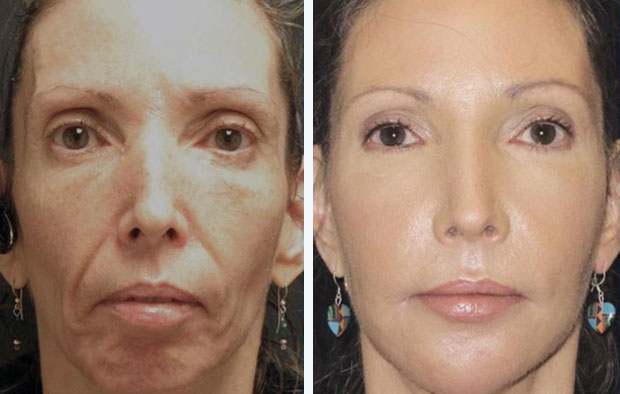 Bioplastia o Biolifting Facial Málaga